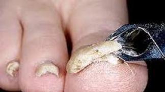 Grzybica paznokci u nóg: leczenie lekami i środkami ludowymi Czym jest grzybica paznokci u nóg