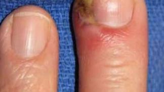 Treatment of inflammation of the nail cuticle