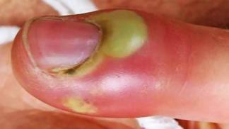 Apsces na prstu blizu nokta - prestupnik: kako liječiti?